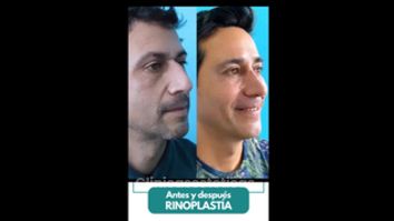 Rinoplastia - Dr. Pedro Vidal G-H