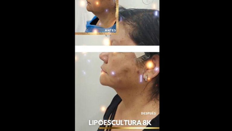 Liposucción facial - Dra. Katherin Ruiz Márquez