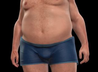 Liposucción HD - Clínica de la Figura