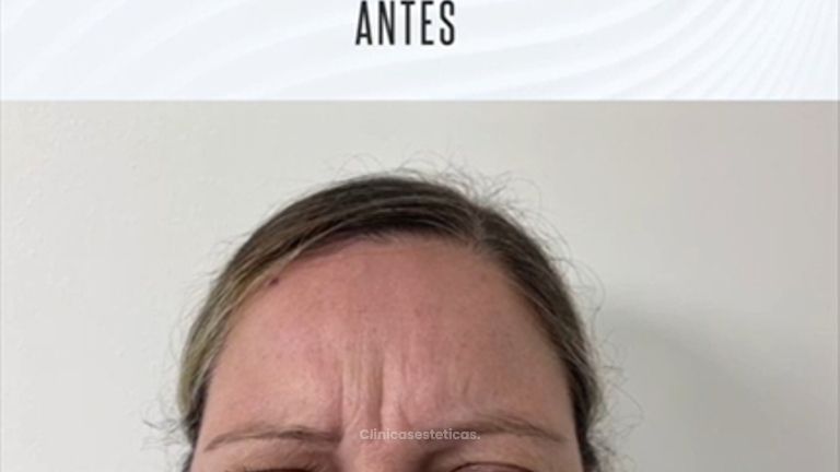 Botox antes y después. 