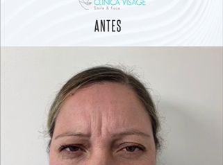 Botox antes y después. 