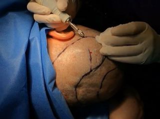 Implante capilar Clínica Primaestetica