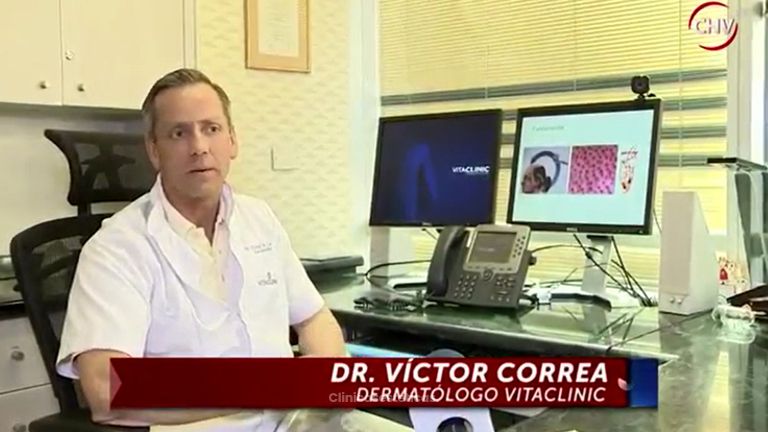 Implante de barba y cejas Vitaclinic