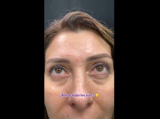 Ojeras - Medicina Estética Integral MD