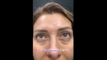 Ojeras - Medicina Estética Integral MD