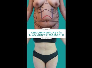 Abdominoplastia - Dr. Pedro Vidal G-H