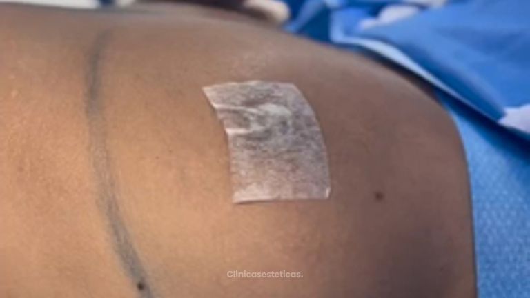 Aumento mamario - Dr Christian Salem Zamorano