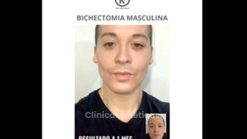 Bichectomía Masculina