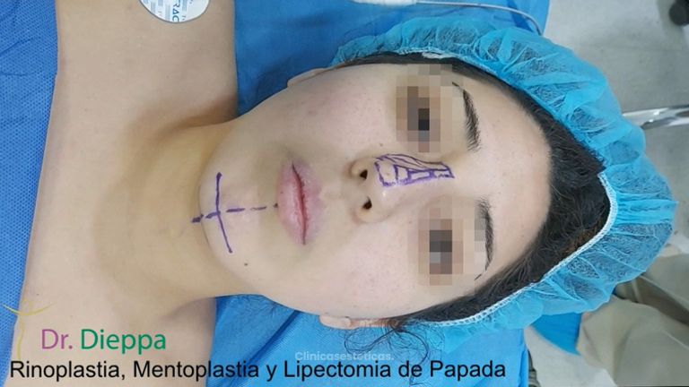 Rinoplastia + Mentoplastia - Cirugía Plástica Dieppa