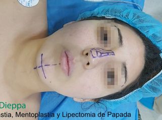 Rinoplastia + Mentoplastia - Cirugía Plástica Dieppa