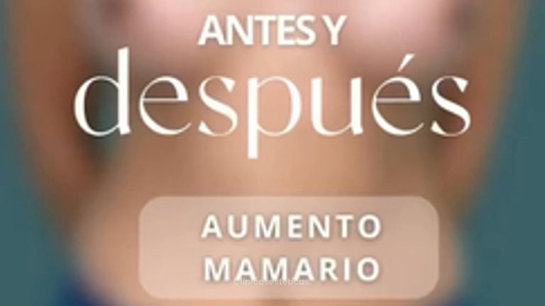 Aumento Mamario - Dr. Vicente Sánchez Liberona