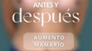 Aumento Mamario - Dr. Vicente Sánchez Liberona