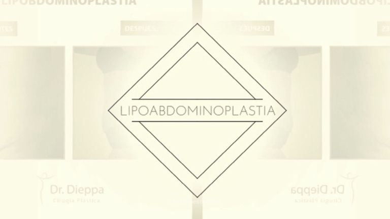 Lipoabdominoplastia - Cirugía Plástica Dieppa