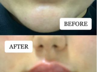 Antes y después Aumento de labios.