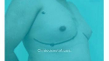 Ginecomastia - Dr. Claudio Silva Vergara