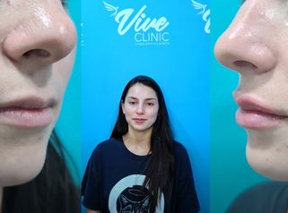 Testimonio - Relleno y Perfilado de Labios - Viveclinic