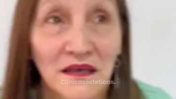 Blefaroplastia - Dr. Sebástian Cosentino