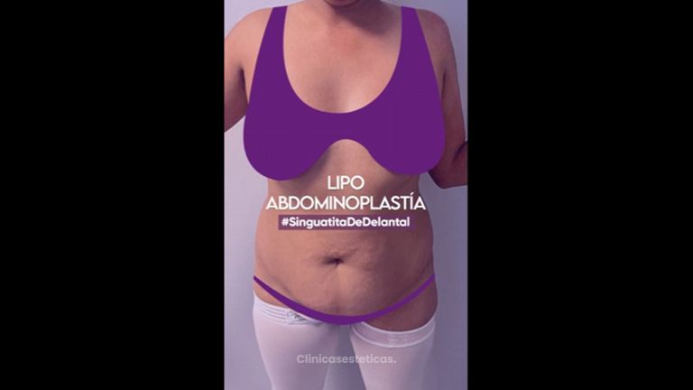 Lipoabdominoplastia - Clínica Anastasia