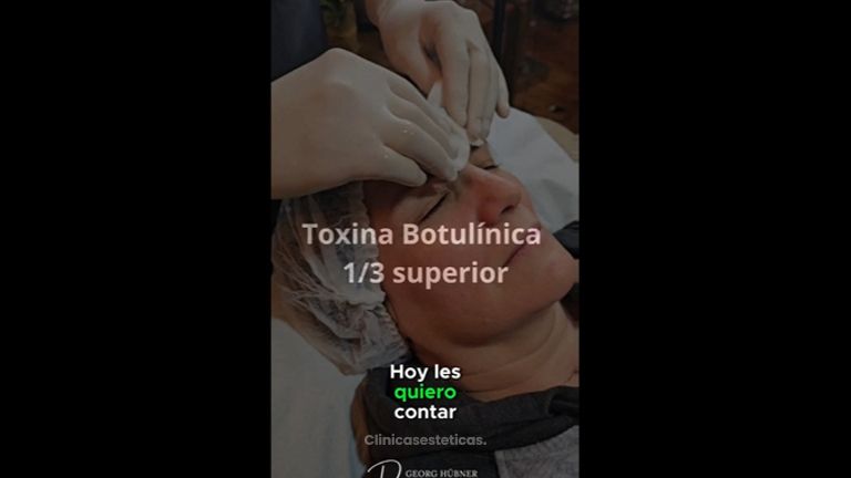 Toxina Botulínica - Dr. Georg Hübner Arancibia
