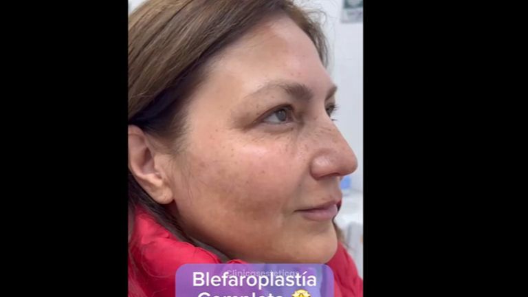 Blefaroplastia - Medicina Estética Integral MD