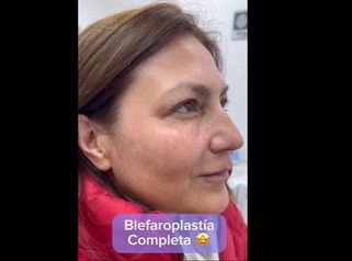 Blefaroplastia - Medicina Estética Integral MD