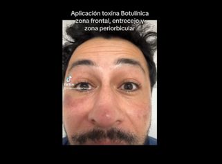 Toxina Botulínica - Dermo Studio & Beauty
