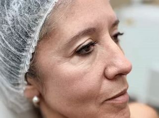 Armonización Facial -Clínica Visage