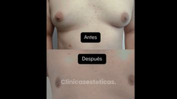 Ginecomastia - Clínica Oviedo