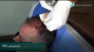 Alopecia y tratamiento Alopecia y tratamiento