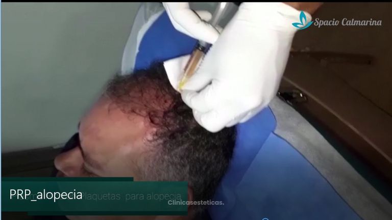Alopecia