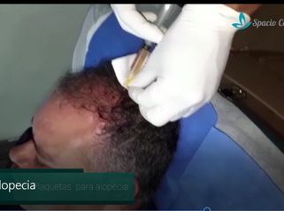 Alopecia