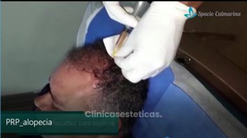 Alopecia