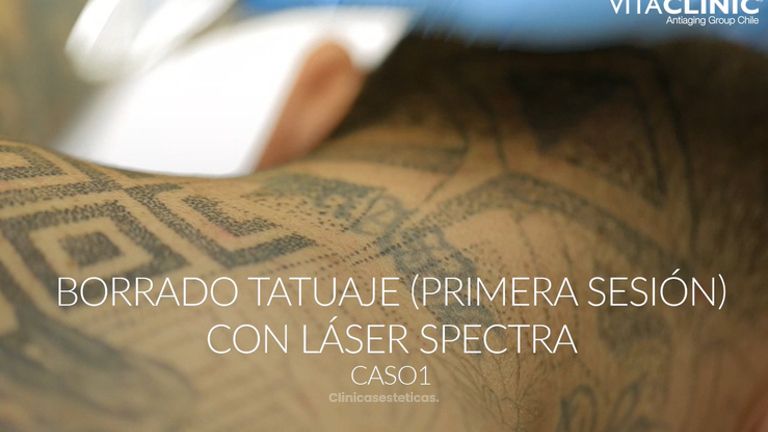 Borrado tatuaje con láser Spectra - Vitaclinic