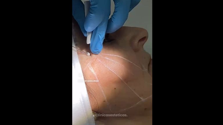 Hilos Tensores - Dermo Studio & Beauty