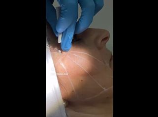 Hilos Tensores - Dermo Studio & Beauty