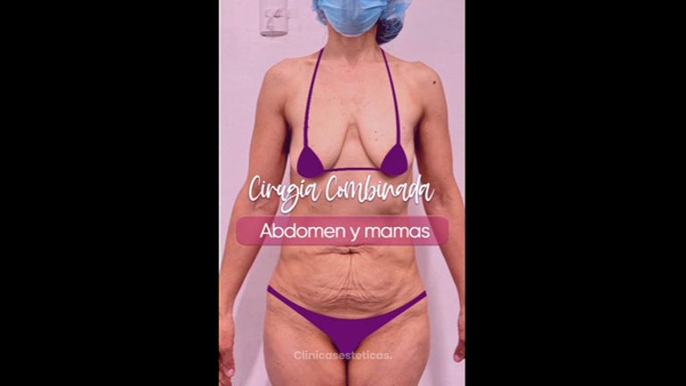 Abdominoplastia + Aumento mamario - Clínica Anastasia