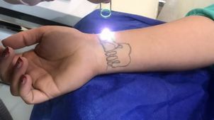 Borrar tatuaje Borrar tatuaje