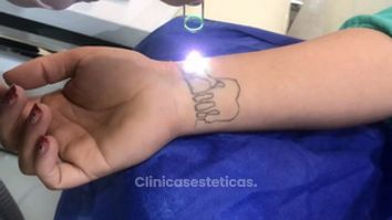Borrado de tatuaje