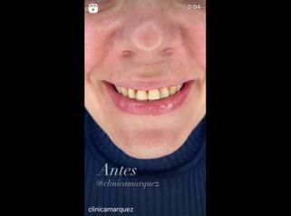 Carillas dentales - Dra. Katherin Ruiz Márquez