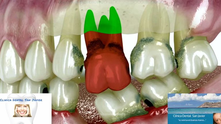 Alteración dental progresiva