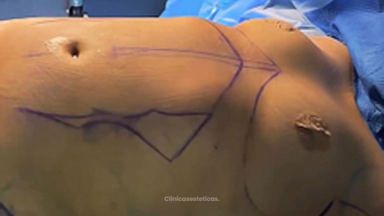 Abdominoplastia - Dr. Matías Kufeke