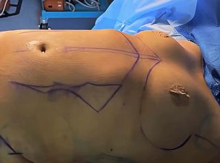 Abdominoplastia - Dr. Matías Kufeke