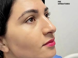 Rinoplastia Ultrasonica - Dra. Angélica Sifontes Muñoz
