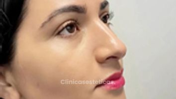 Rinoplastia Ultrasonica - Dra. Angélica Sifontes Muñoz