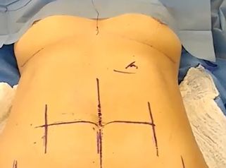 Lipoabdominoplastia
