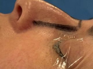 Rinoplastía - Cirugía Plástica Dieppa