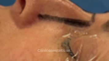 Rinoplastía - Cirugía Plástica Dieppa