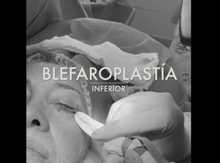 Blefaroplastia - Clínica Doctor Flores Aqueveque