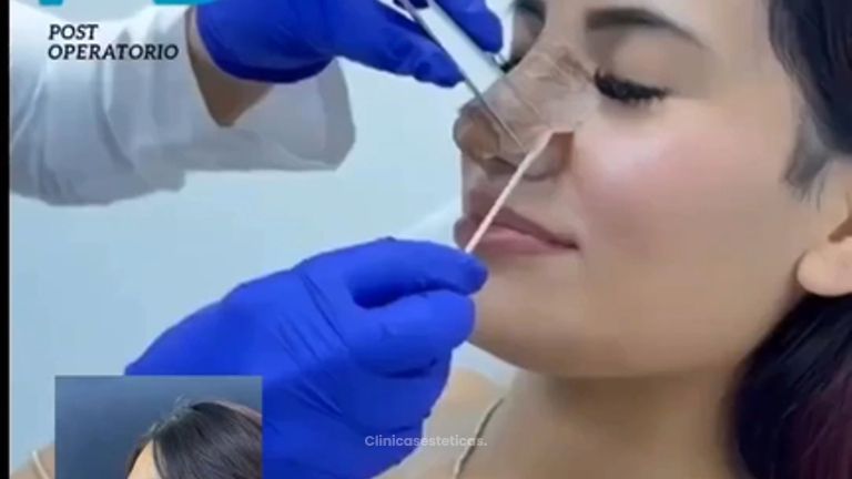 Rinoplastia - Dra. Angélica Sifontes Muñoz