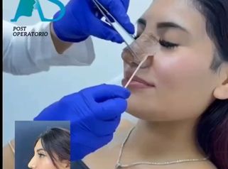 Rinoplastia - Dra. Angélica Sifontes Muñoz